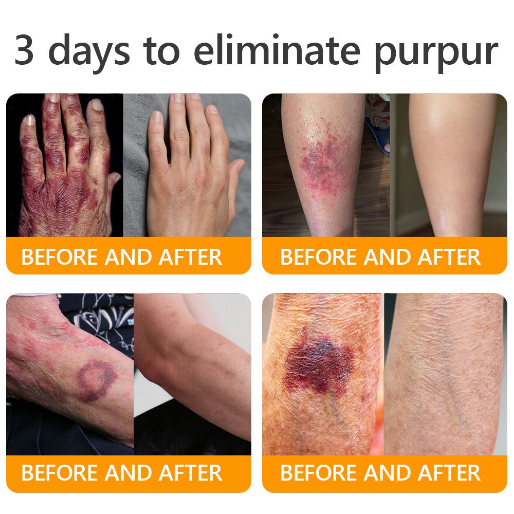 𝐌𝐇𝐑𝐀 𝖮𝖿𝖿𝗂𝖼𝗂𝖺𝗅 𝖲𝗍𝗈𝗋𝖾 👨⚕️ Made and Shipped from UK ✨✨ APKAPK® Bee venom Comprehensive Cream 🔥 LAST DAY 80% OFF 💎💎💎